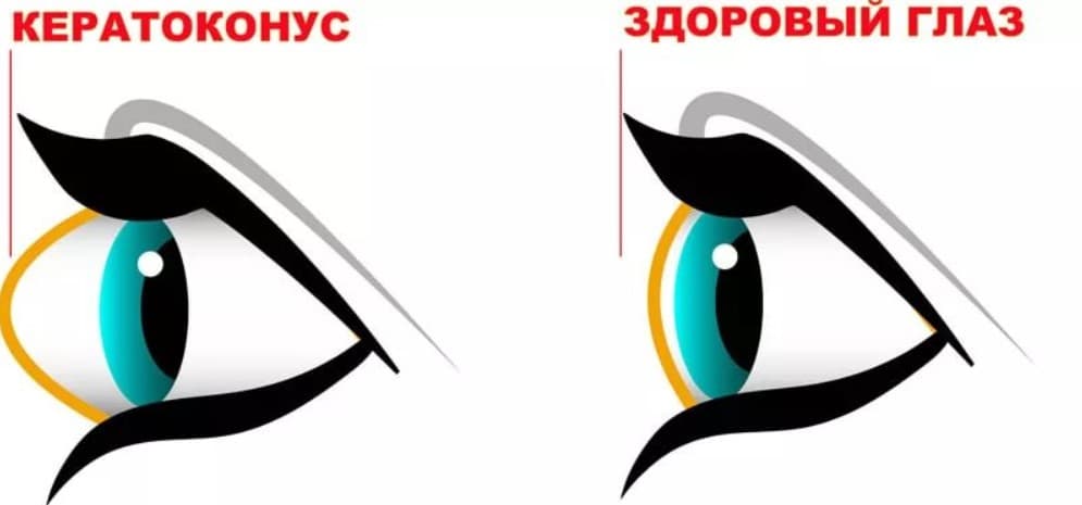 Кератоконус