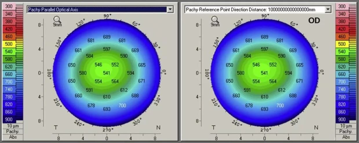 Показатели пахиметрии и их расшифровка в офтальмологии