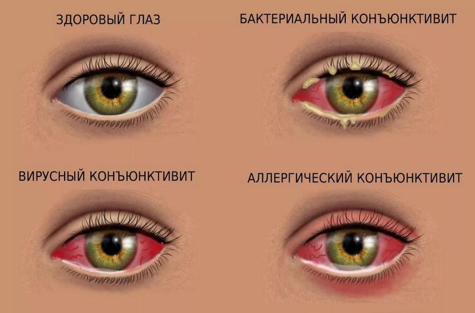Симптомы конъюнктивитов