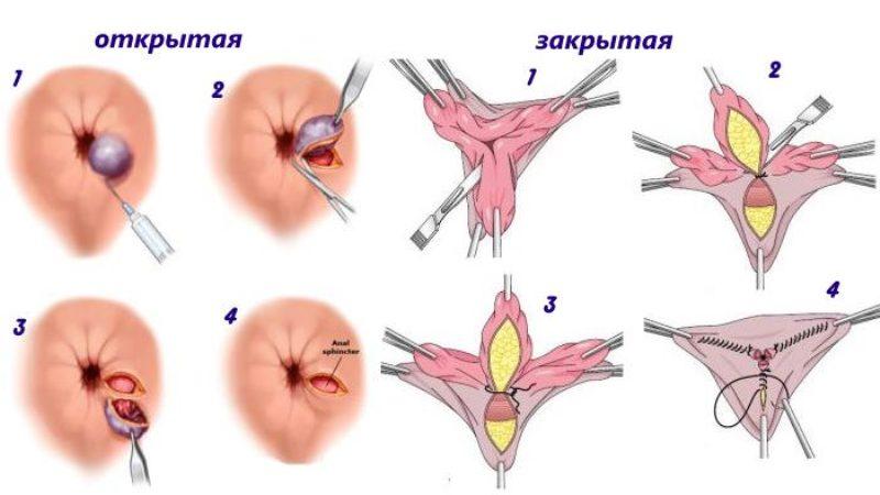 последняя стадия геморроя