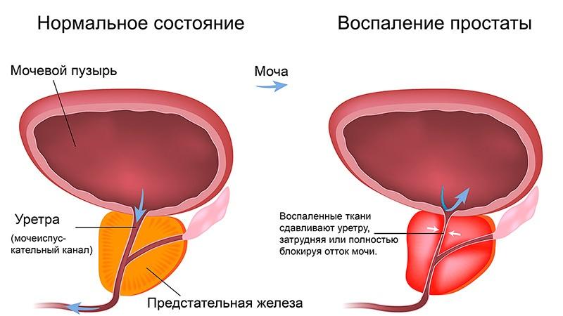 признаки аденомы простаты и простатита