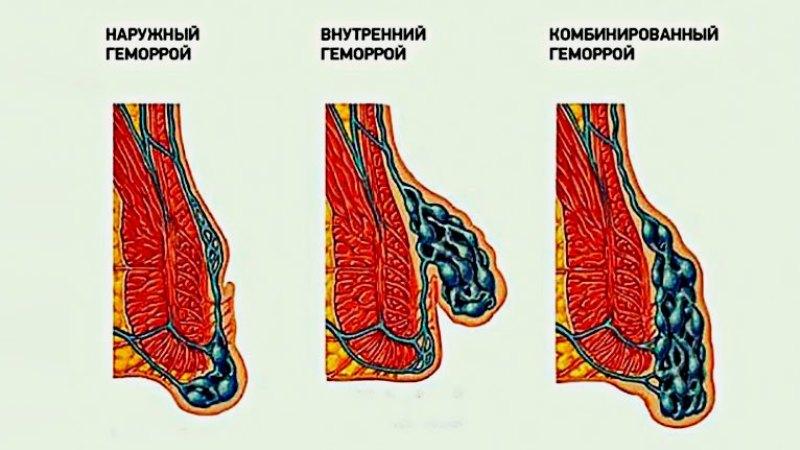 алкоголь и геморрой взаимосвязь