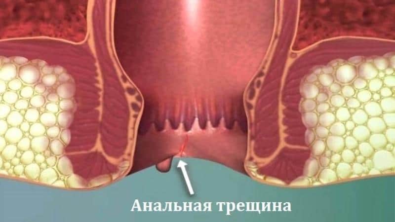 анальная трещина симптомы