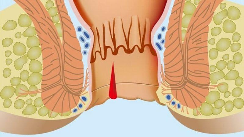 трещина в заднем проходе фото смотреть