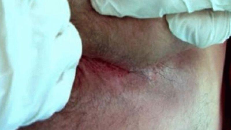 анальная трещина хроническая