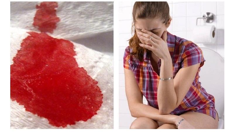 анальной трещины признаки