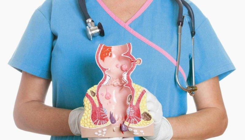 Детралекс и его аналоги при лечении геморроя