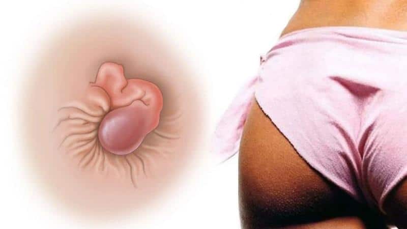 Анестезол свечи от геморроя: инструкция по применению и отзывы