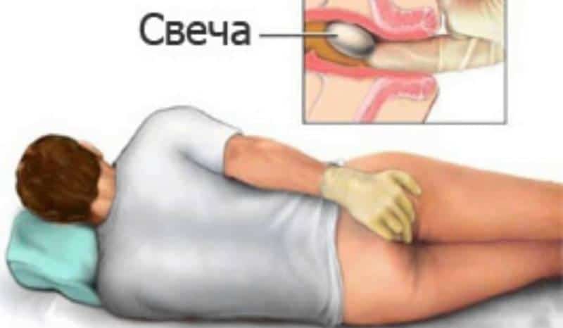 Анестезол свечи от геморроя: инструкция по применению и отзывы