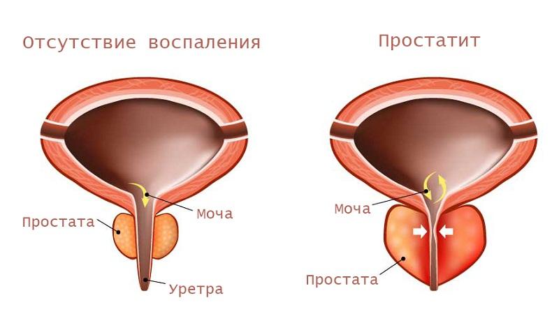 антибиотики для лечения простатита у мужчин