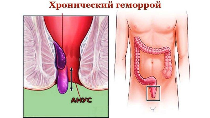 анус влажный