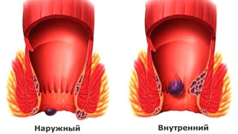 мокнущий геморрой симптомы и лечение
