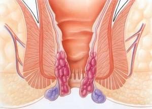 Как принимать аспирин для лечения геморроя и отзывы