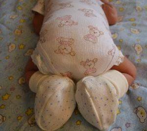 атрезия заднего прохода и прямой кишки