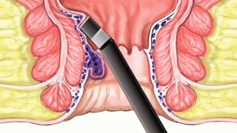 Безоперационные методы лечения геморроя