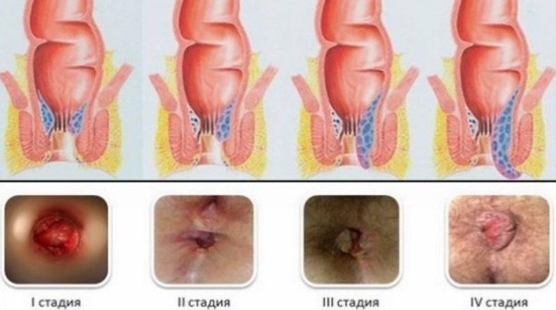 боль после дефекации в заднем проходе