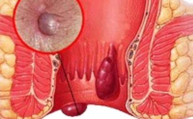 боль в заднем проходе отдает в животе