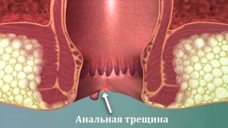 сильно болит низ живота и отдает в заднем проходе