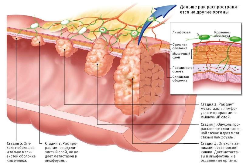рак прямой кишки
