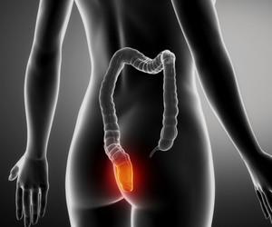 Что такое бужирование прямой кишки - как лечить сужение заднего прохода