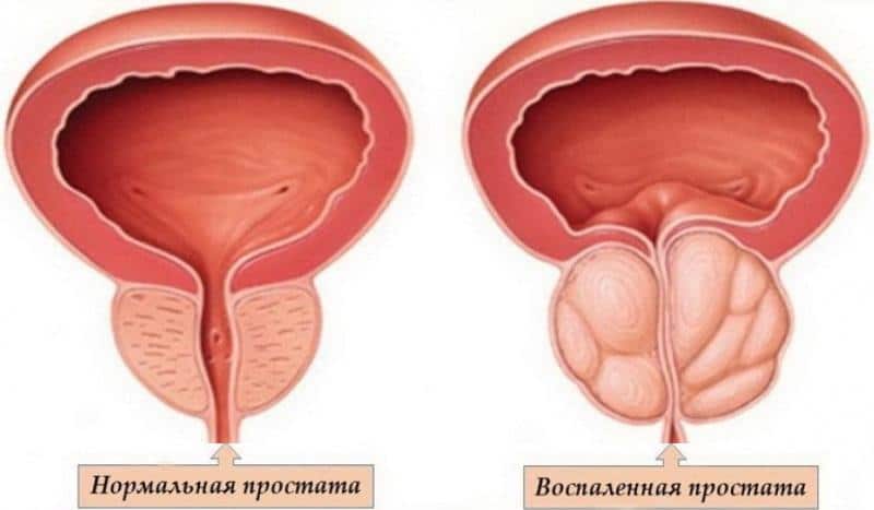 быстрое лечение простатита у мужчин лечение в домашних условиях