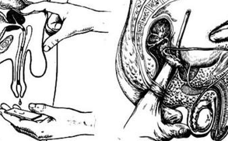 хронический простатит симптомы и лечение в домашних условиях