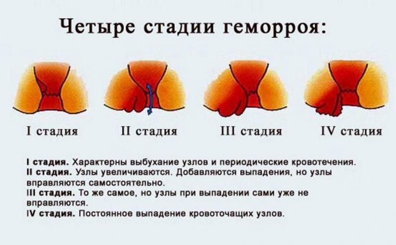 Последствия геморроя - чем он опасен если не лечить
