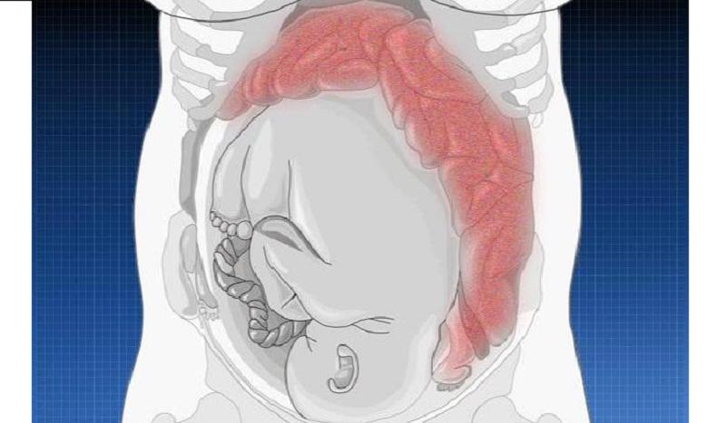 во время беременности запор причины