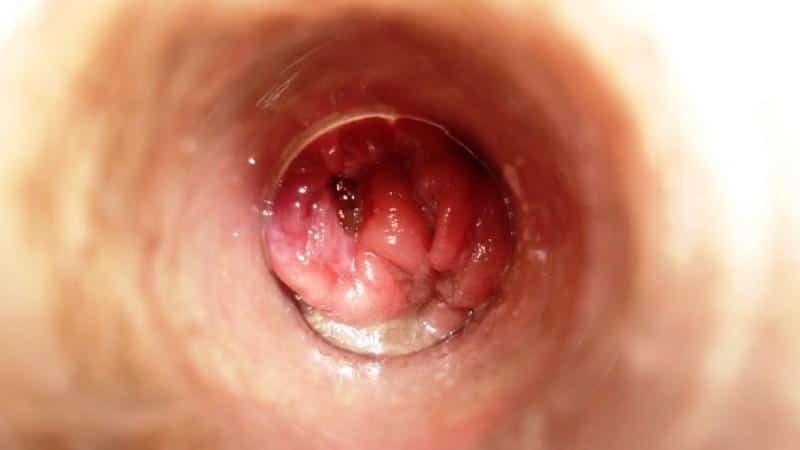 что такое геморрой и как его лечить как он выглядит