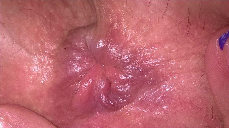 внутренний геморрой фото