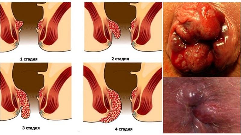геморрой картинки