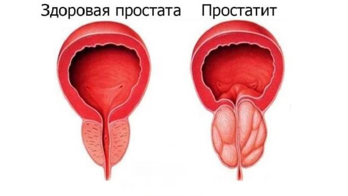 что такое простатит