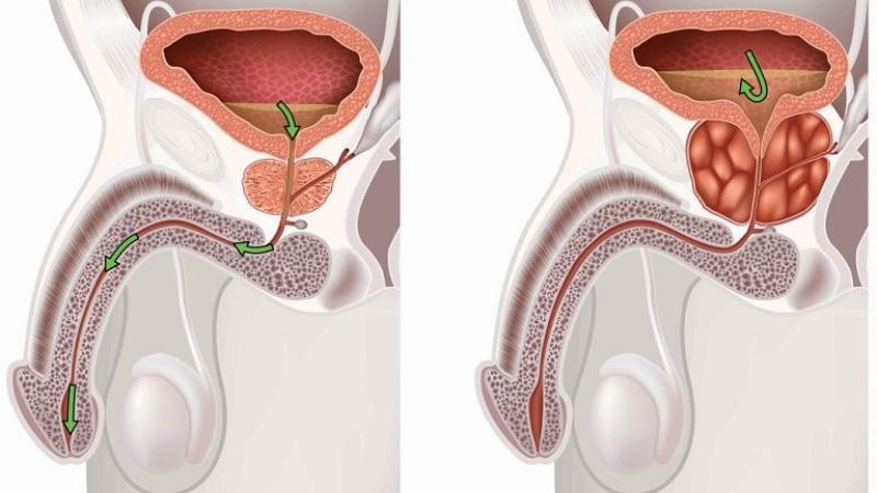 какие первые симптомы мужского простатита
