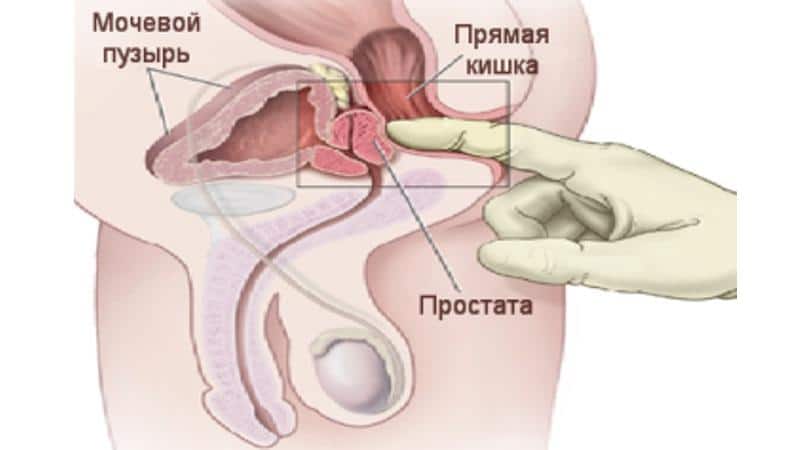 признаки простатита у мужчин и чем лечить