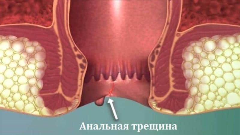 чувство распирания в заднем проходе причины
