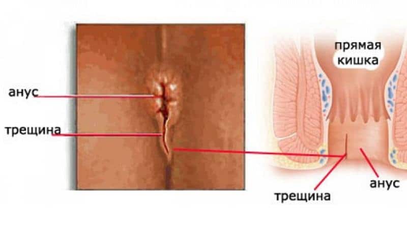 диета при анальных трещинах