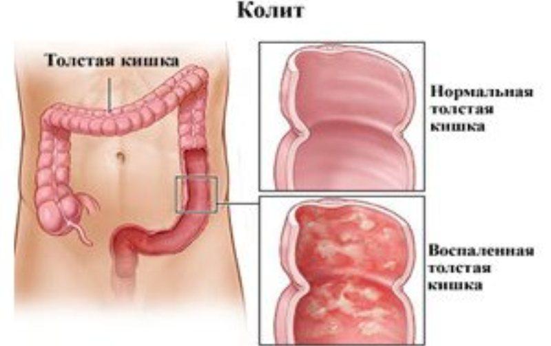 диета при колитах и раздраженном кишечнике