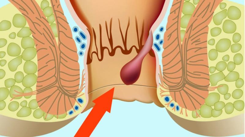 диета при обострении геморроя с кровотечением