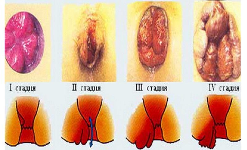 диклофенак мазь при геморрое
