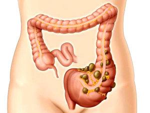 Что такое дивертикулярная болезнь толстой кишки и как её лечить