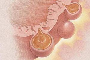 Что такое дивертикулярная болезнь толстой кишки и как её лечить