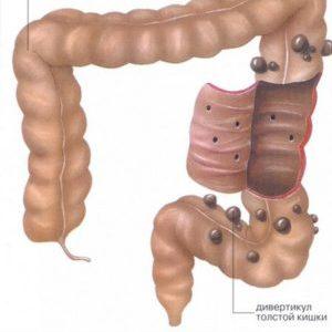 Что такое дивертикулярная болезнь толстой кишки и как её лечить