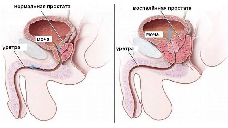 диета при хроническом простатите у мужчин