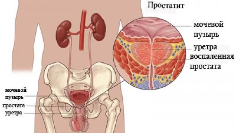 Препарат Ципрофлоксацин в лечении простатита - инструкция и отзывы