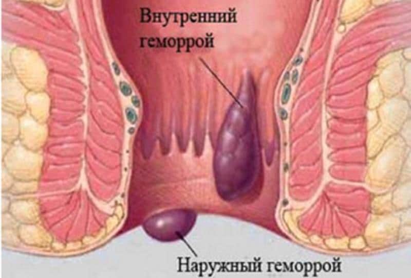 эффективное лечение геморроя в домашних условиях
