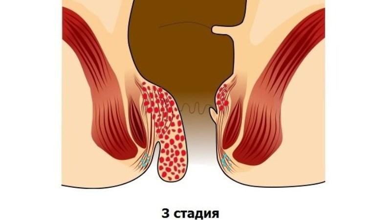 чем в домашних условиях лечить геморрой