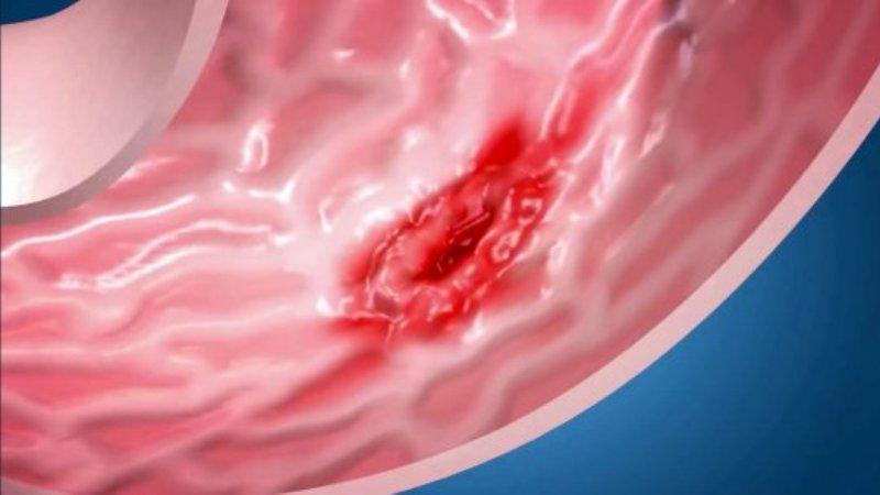 эрозия прямой кишки симптомы лечение