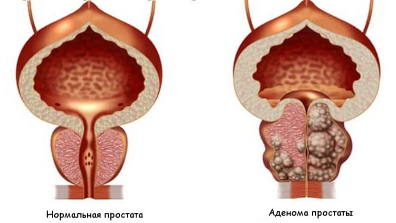 нормальная простата и с аденомой