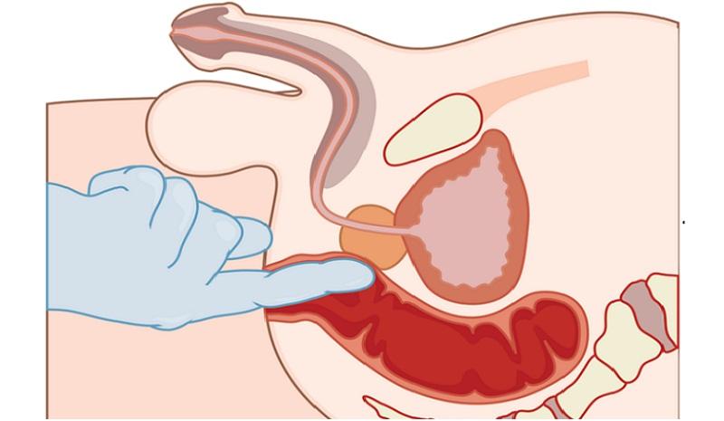массаж простаты пальцем