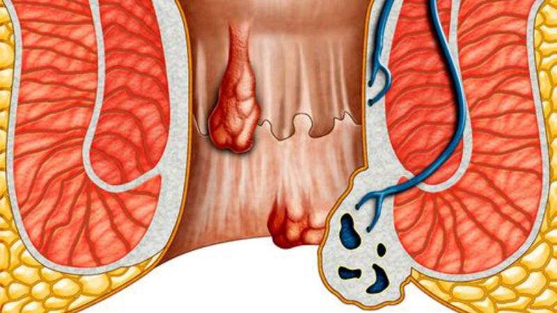 Препарат Флебодиа 600 при лечении геморроя: инструкция и отзывы